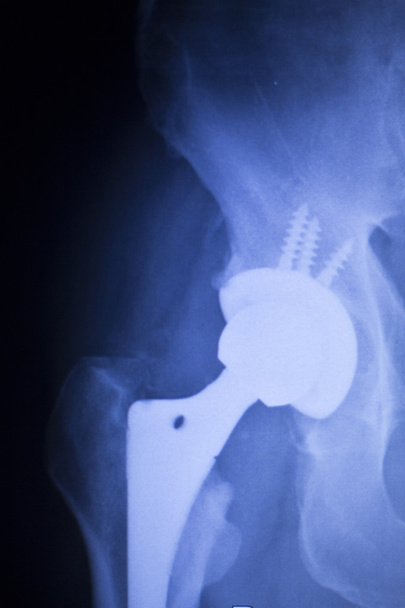 人工股関節置換術の x 線の整形外科医療スキャン - 写真・画像