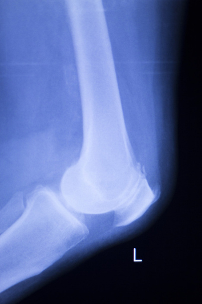 Röntgenbild einer Knie- und Meniskusverletzung - Foto, Bild