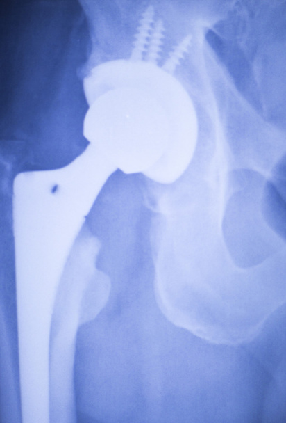 Radiografía de reemplazo de cadera exploración médica ortopédica
 - Foto, imagen