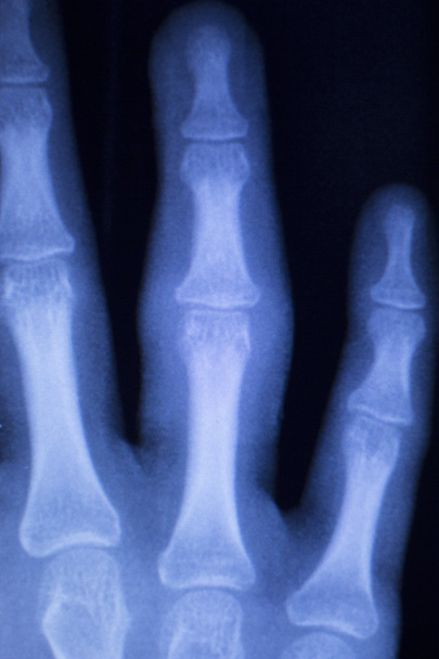 Kéz ujjai xray scan - Fotó, kép