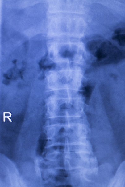 Vértebra vertebral lesión lumbar exploración por rayos X
 - Foto, imagen