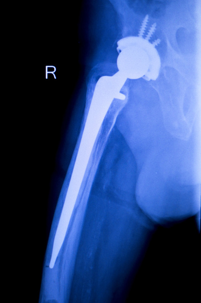 Kalça protezi xray ortopedi tıbbi tarama - Fotoğraf, Görsel