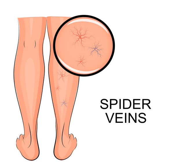 spider veins on legs - Vector, Image