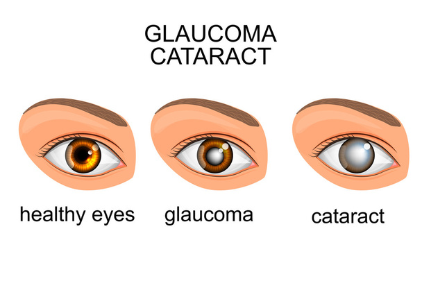 ojos sanos, glaucoma, cataratas
 - Vector, Imagen