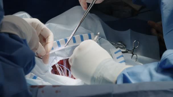 Sebészek egy nyitott szívműtét közben - Felvétel, videó