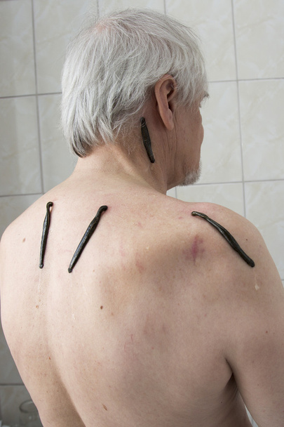 Tratamiento con sanguijuelas zona del hombro y cuello, zona de la espalda en el
  - Foto, Imagen