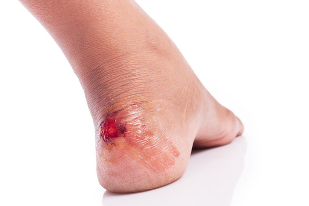 wound at heel on white background - Photo, Image
