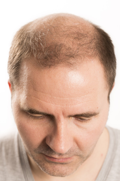 Kaalheid Alopecia man haar verlies haarverzorging - Foto, afbeelding