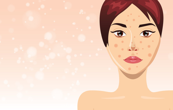 Acne treatment with beautiful woman face, vector illustration - Vector, Image