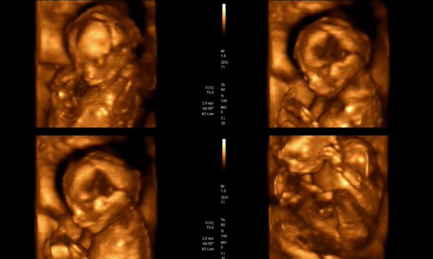 Collage d'images médicales d'échographie 4D pendant la grossesse de la femme s
 - Photo, image