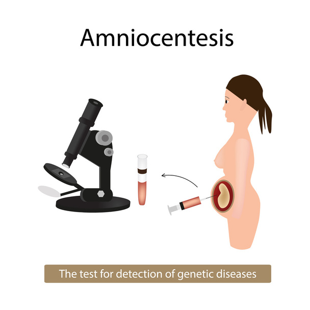 Amniocentèse. Analyse du liquide amniotique. Une femme enceinte. Maladies génétiques. Illustration vectorielle sur fond isolé
 - Vecteur, image