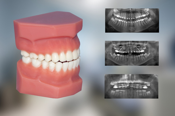 stomatologicznych modelu: leczenie ortodontyczne - Zdjęcie, obraz