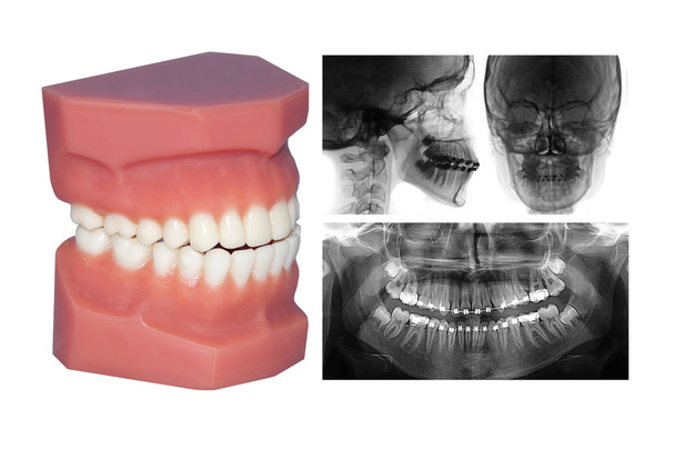 tanden model en cephalometric x-ray geïsoleerd op met - Foto, afbeelding