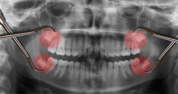 visualizzare quattro denti del giudizio a raggi X
 - Foto, immagini