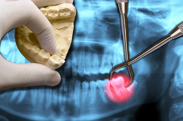 dentista mão mostrar dente molar
 - Foto, Imagem