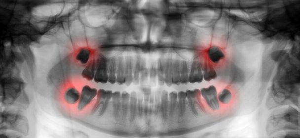 zubní kontroly radiografie - Fotografie, Obrázek