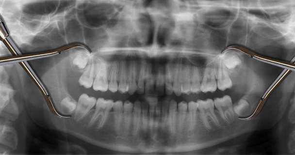 orthodontic tool over x-ray dental scan show wisdom teeth - Photo, Image
