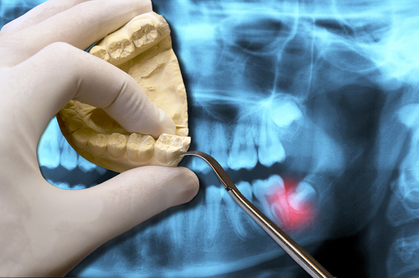 стоматолог с помощью ортодонтического инструмента показывает зубную боль мудрости
 - Фото, изображение