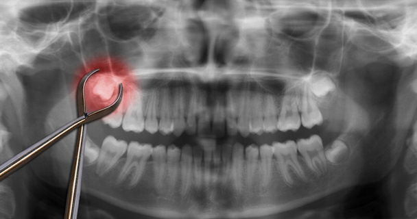 Orthodontische gereedschap Toon wijsheid kiespijn - Foto, afbeelding