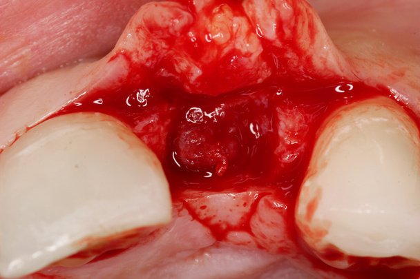 cirugía dental vista del implante
 - Foto, imagen