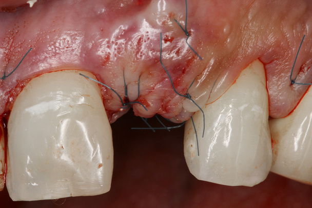 δόντι χειρουργική επέμβαση εμφυτεύματος προβολή - Φωτογραφία, εικόνα
