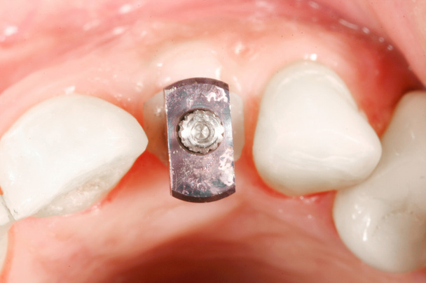 fogat műtét implantátum megtekintése - Fotó, kép