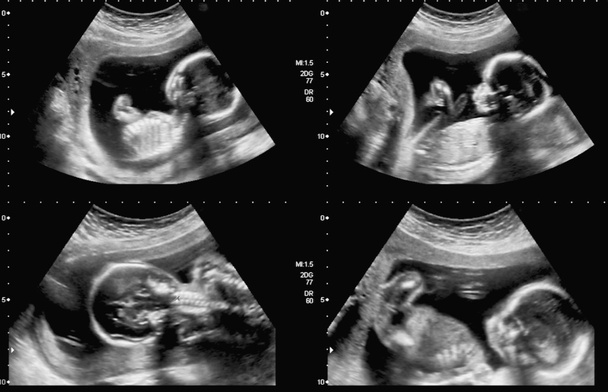 Medical images collage of ultrasound during woman pregnancy show - Photo, Image