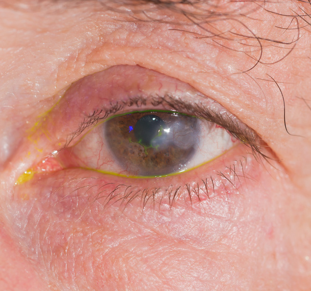 Queratitis por herpes. en la prueba ocular
 - Foto, Imagen