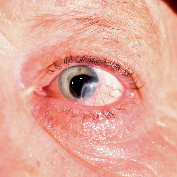 ojo con iris perdido y cicatriz corneal
. - Foto, Imagen
