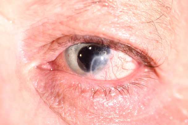 ojo con iris perdido y cicatriz corneal
. - Foto, Imagen