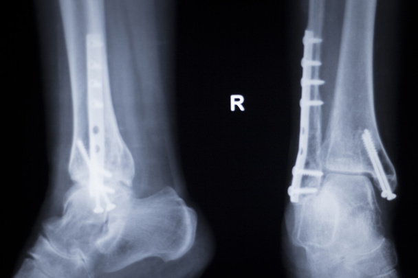 Ankle injury metal implant xray scan - Photo, Image