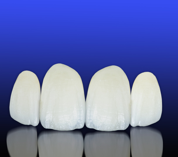 Coronas dentales de cerámica sin metal - Foto, Imagen