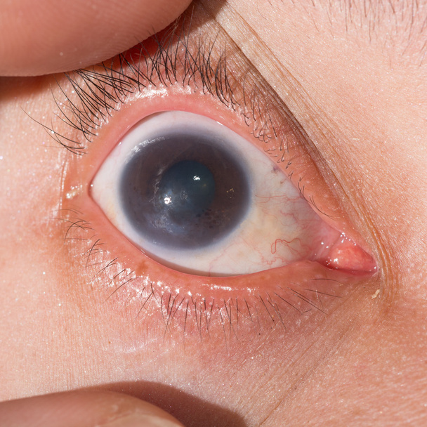 視力検査で角膜炎 - 写真・画像