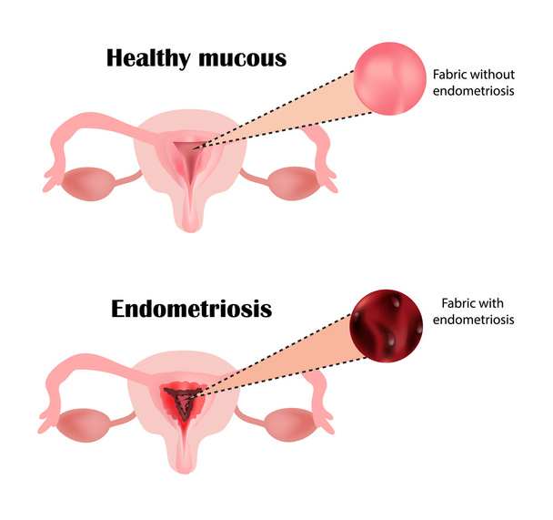 Endometriosis. The structure of the pelvic organs. Adenomyosis. The endometrium. Vector illustration - Vector, Image