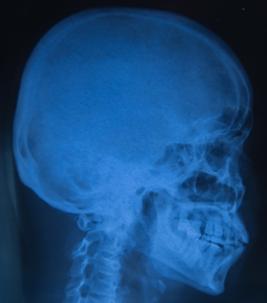 Вид плівкового рентгенівського черепа людини
 - Фото, зображення