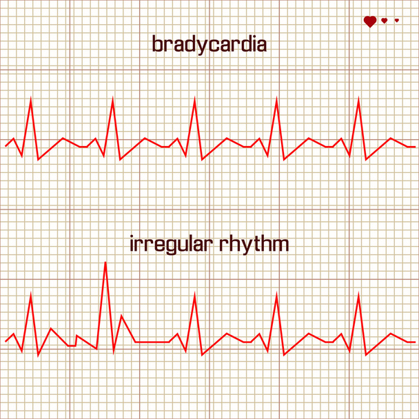 Векторна серцебиття кардіограма
 - Вектор, зображення