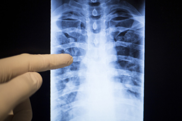 Wirbelsäule Rücken Hals Röntgenbild - Foto, Bild