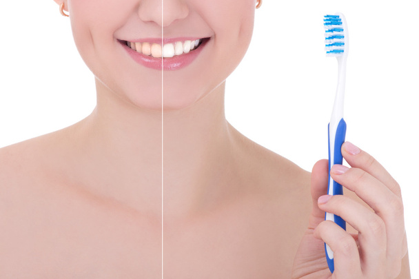 dents blanchissant avant et après le concept - souriant avec de - Photo, image