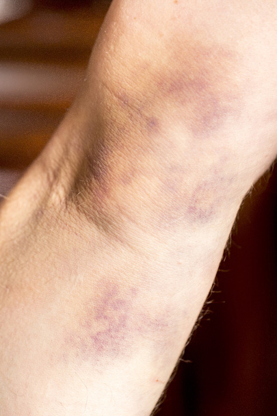 large hematoma on human arm - Photo, Image