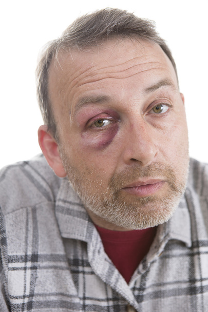 Middle-aged Caucasian male Emotional Portrait with a Real Bruise - 写真・画像