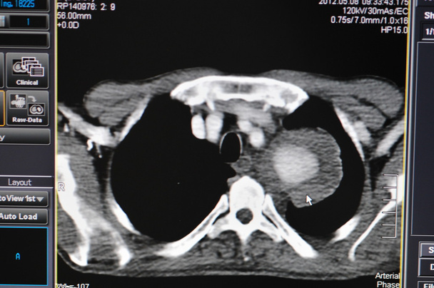 Lung ct - Photo, Image