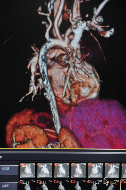 Ct cardiaco
 - Foto, Imagen