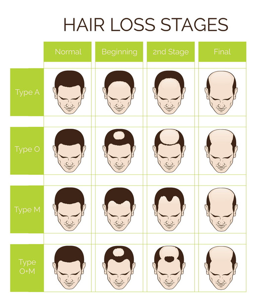 Etapas y tipos de pérdida de cabello para hombres
 - Vector, Imagen