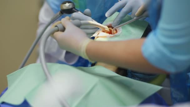 Dentysta działa zęby pacjenta kobieta specjalnych urządzeń - Materiał filmowy, wideo