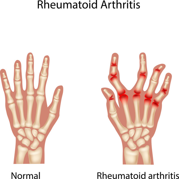Ilustración de Artritis reumatoide
 - Vector, imagen