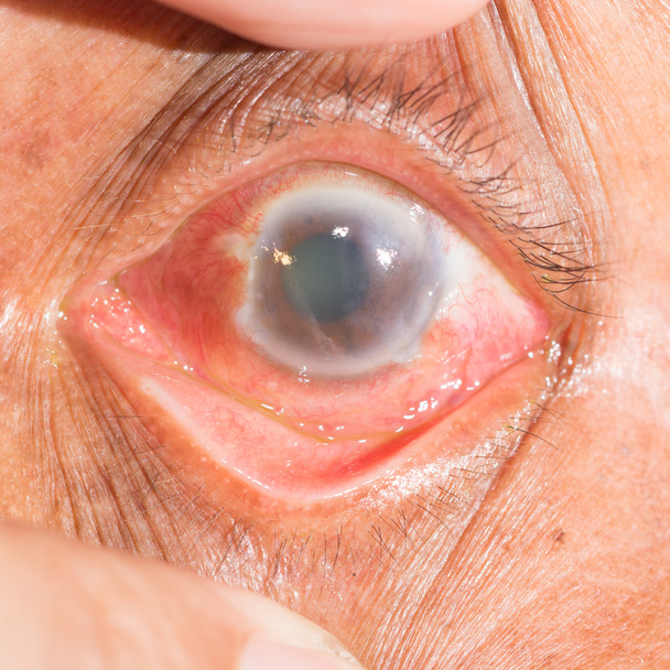 glaucoma de fechamento de anjo no teste ocular
 - Foto, Imagem
