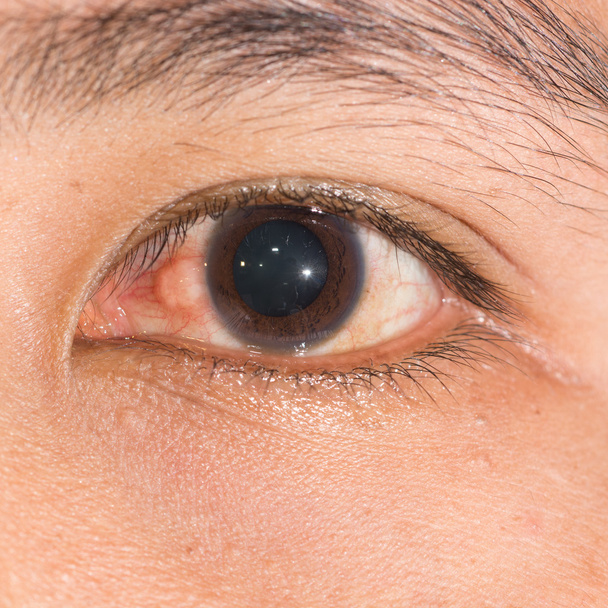 nodulair episcleritis op oogtest - Foto, afbeelding