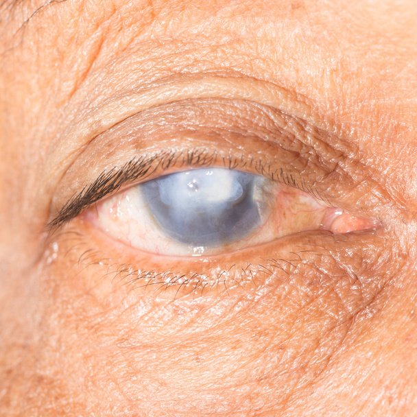視力検査で角膜の瘢痕 - 写真・画像
