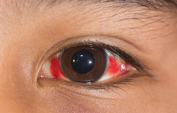 視力検査で結膜下出血 - 写真・画像