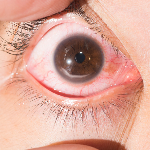 queratite marginal no teste ocular
 - Foto, Imagem